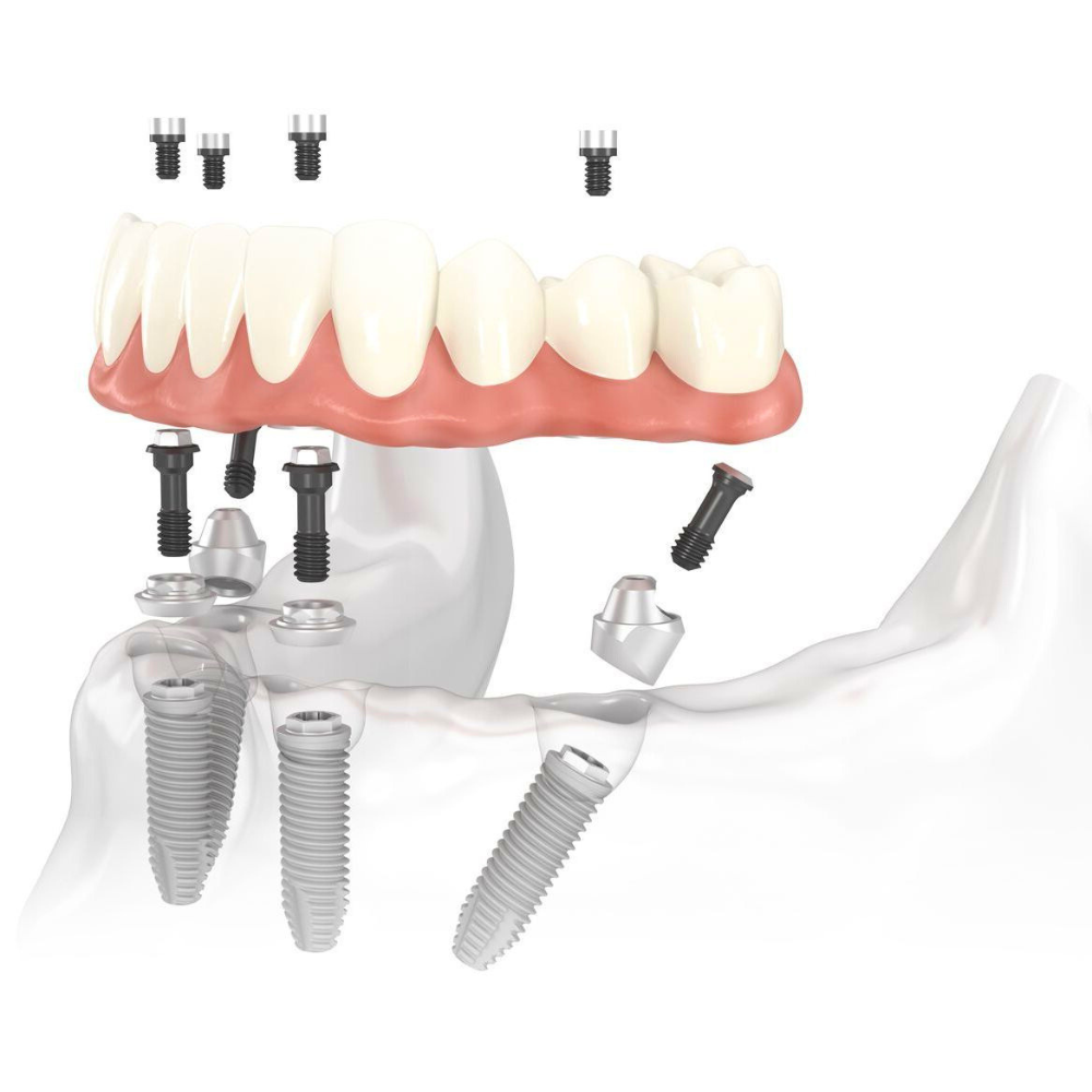 All-on-X fogimplantátum