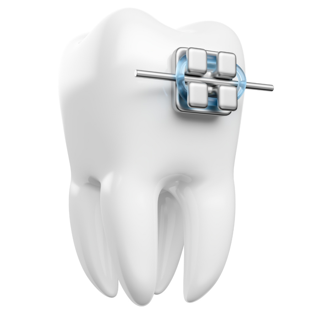Fogszabályozás gyermekeknek
