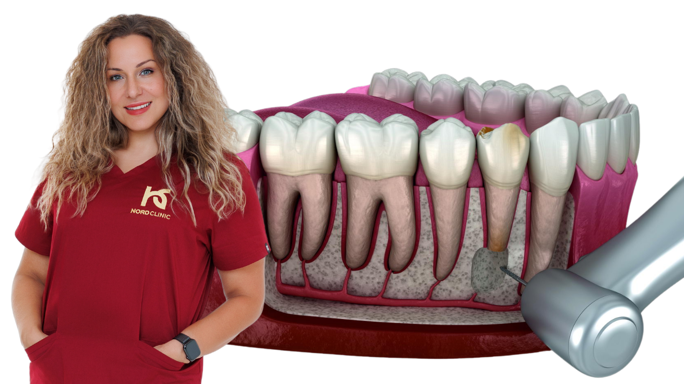 Gyökércsúcs rezekció