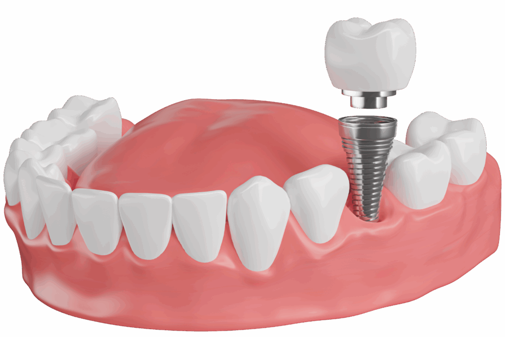 Implatológia fogbeültetés