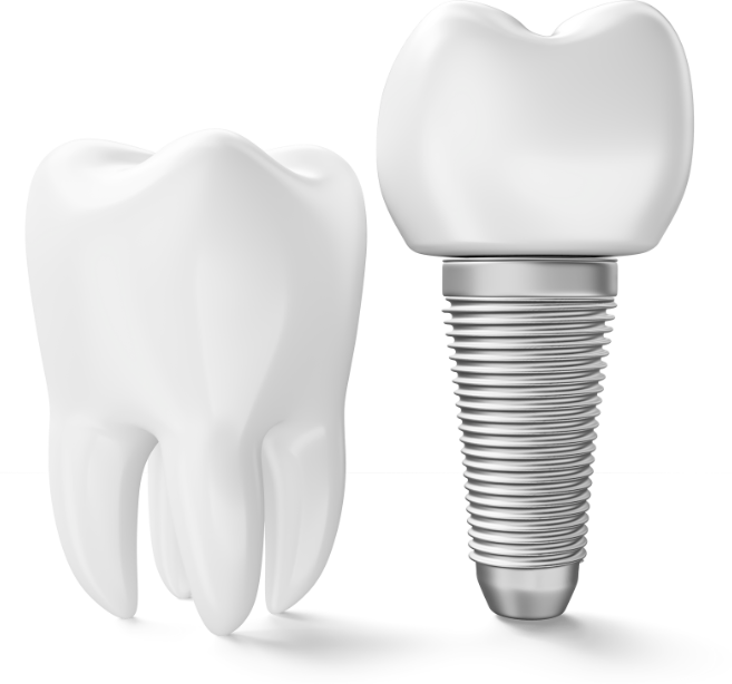 Implatológia fogbeültetés NordDental