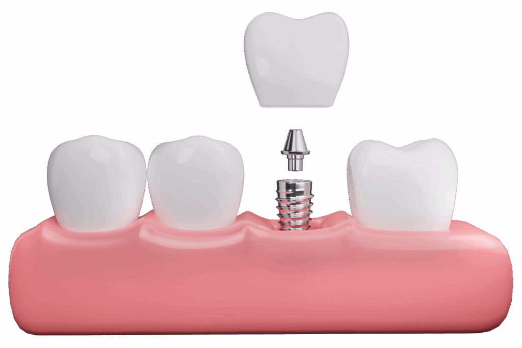 Implatológia fogpótlás fogbeültetéssel