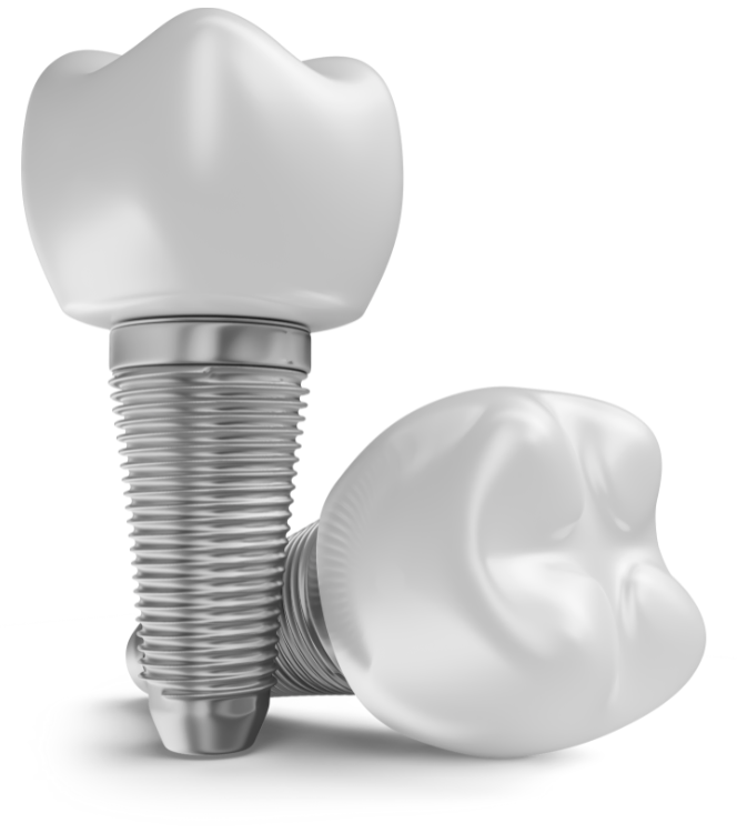 fogimplantátum szájsebészet